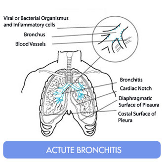 bronchitis pictures