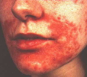 Perioral Dermatitis