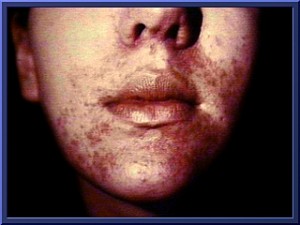 Perioral Dermatitis