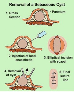 epidermal cyst removal