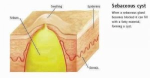 Sebaceous cyst