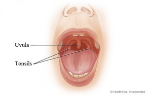 Swollen Uvula photo