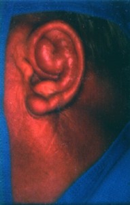 cauliflower ear treatment