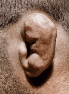 cauliflower ear photos