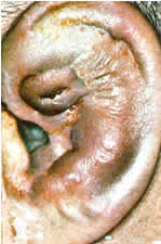 Cauliflower Ear picture