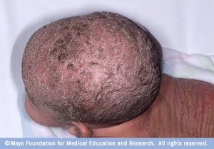 cradle cap pictures