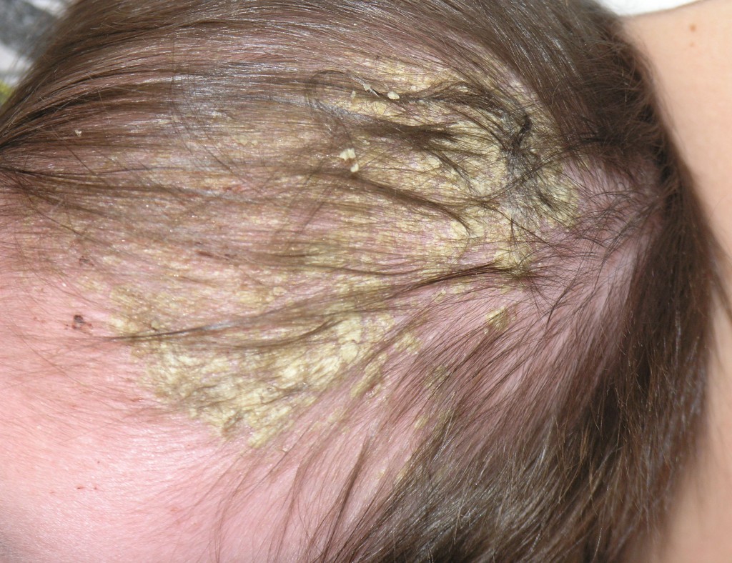 Cradle Cap Symptoms, Causes, Pictures, Treatment and Home Remedies
