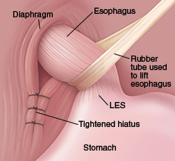 hiatus hernia surgery