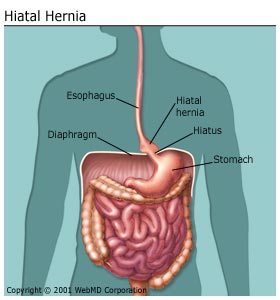 hiatus hernia picture