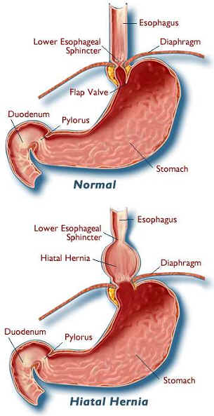 Hiatus (Hiatal) Hernia – Symptoms, Causes, Pictures, Diet and Surgery