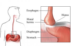 hiatal hernia