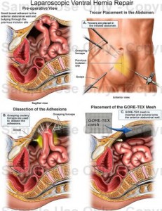 ventral hernia repair