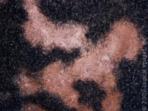 pictures of tinea capitis