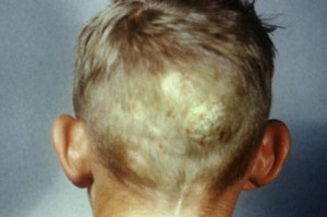 scalp ringworm pictures