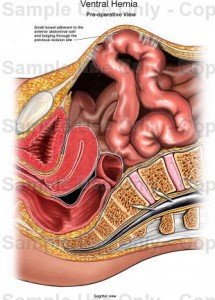 pictures of ventral hernia