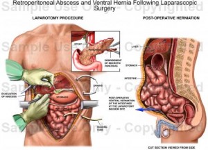 ventral hernia