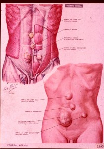 ventral hernia