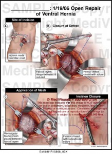 hernia ventral surgery