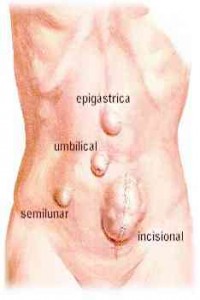 ventral hernia picture