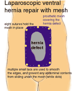 ventral hernia mesh