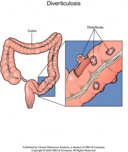 photos of Diverticulosis