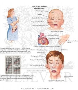 Fetal Alcohol Syndrome pictures