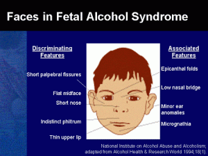 picture of Fetal Alcohol Syndrome