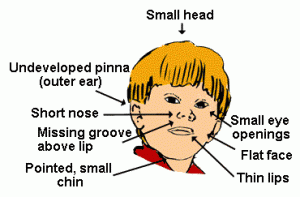 pictures of Fetal Alcohol Syndrome
