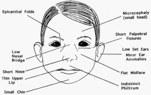 Fetal Alcohol Syndrome symptoms