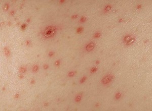 pictures of Maculopapular Rash