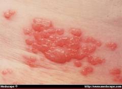 Maculopapular Rash â€