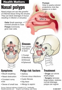 pictures of nasal polyps