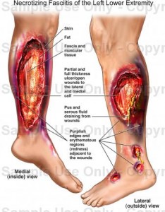 Necrotizing Fasciitis pictures