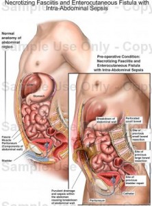 Necrotizing Fasciitis