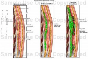 Necrotizing Fasciitis