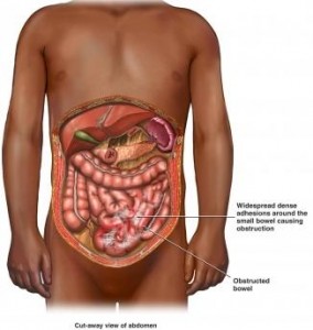 Paralytic Ileus pictures