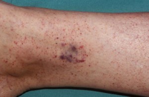 Petechiae pictures