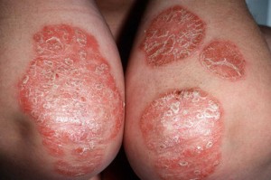 psoriasis pics