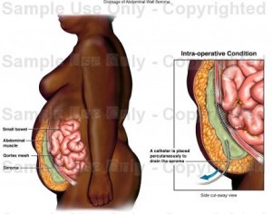 drainage Seroma