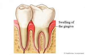 Photos of swollen Gums