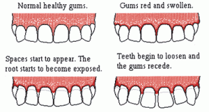 swollen gums