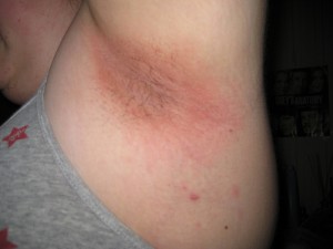 photos of underarm rash