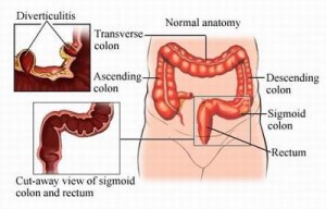 Diverticulitis pictures