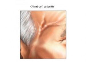 giant cell pictures