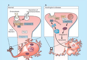 huntingtons disease picture