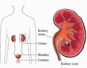 kidney stone pictures