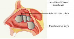 nasal polyp symptoms