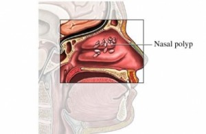 photos of nasal polyps