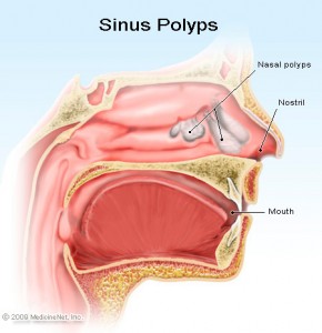 nasal polyps picture
