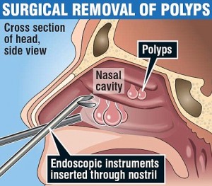 nasal polyps removal